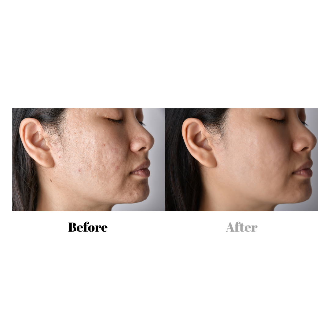 Cellulite removal peptide additive for mixing cream or serum