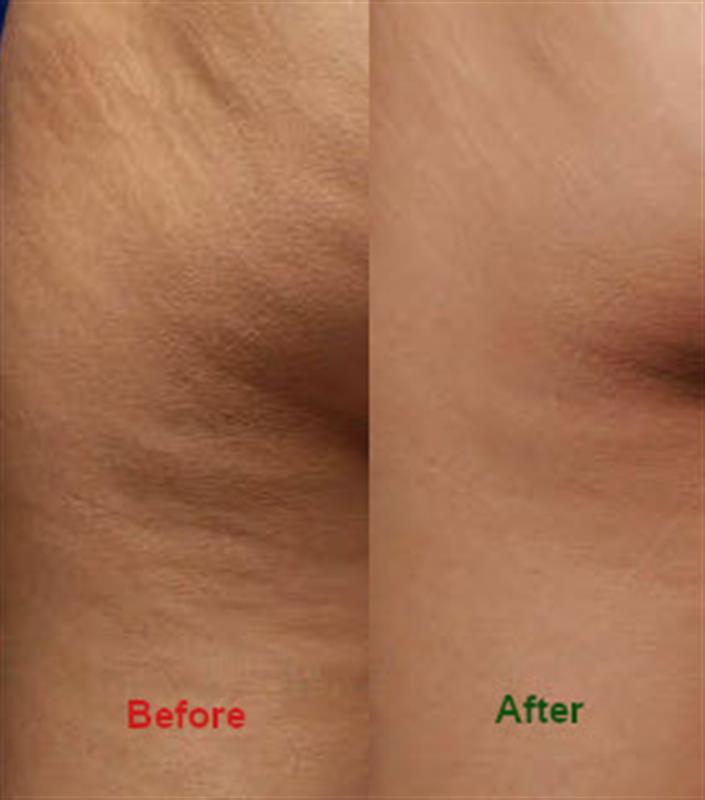 /Bellahut's Dual Cellulite Defense Cream