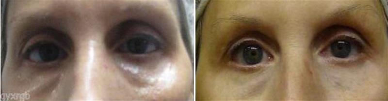 /Dual Eye Gel Set with Haloxyl Eyeliss And Matrixyl 3000 Reduces puffiness, eye bags and dark circles