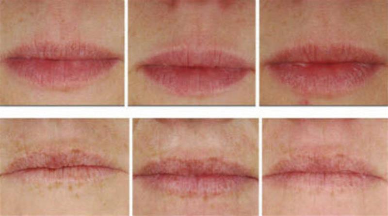 /Upper lip wrinkle cream with Decorinyl, Tri-Peptide-1, Matrixyl 3000 And Hyaluronic Acid